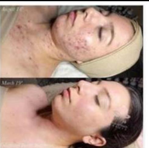 LED Light Therapy for Acne
